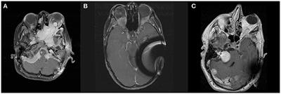 Intra-Orbital Meningioma Causing Loss of Vision in Neurofibromatosis Type 2: Case Series and Management Considerations